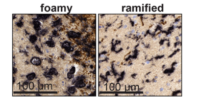 On the left, you can see foamy microglia filled with fat particles, associated with severe MS progression. On the right, you can see branched macrophages associated with normal brain function.